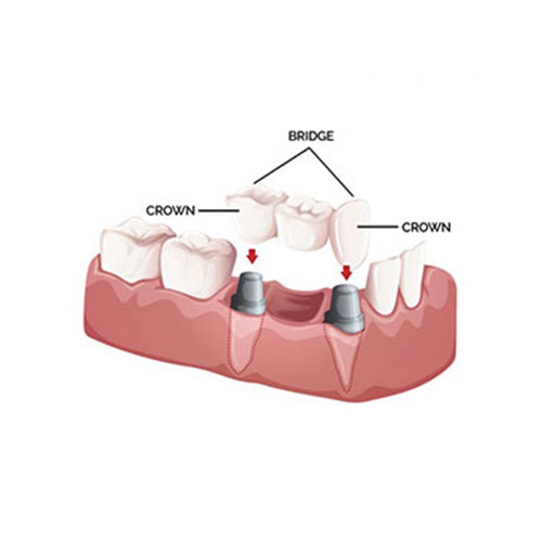 Crowns & Bridges - Double Bay Dentistry